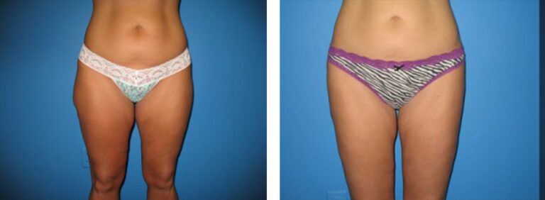 Liposuction-Case-2-1