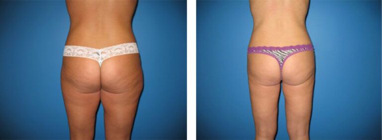 Liposuction-Case-2-2
