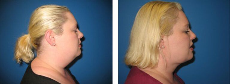 Liposuction-Case-3-1