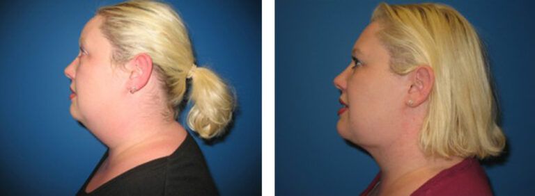 Liposuction-Case-3-2