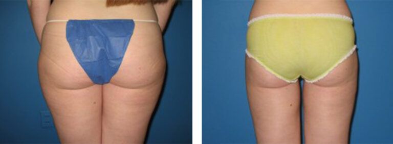 Liposuction-Case-4-1