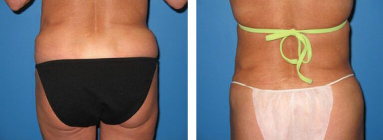 Liposuction-Case-4
