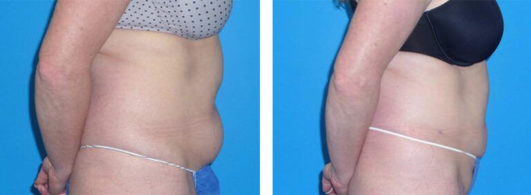 Liposuction-Case-5-1