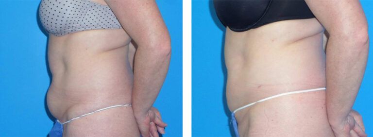 Liposuction-Case-5-2