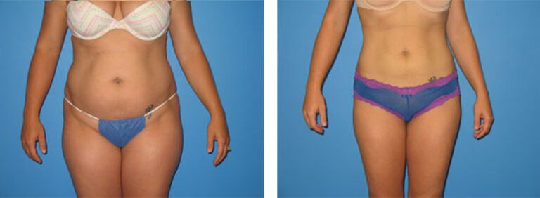 Liposuction-Case-6-1