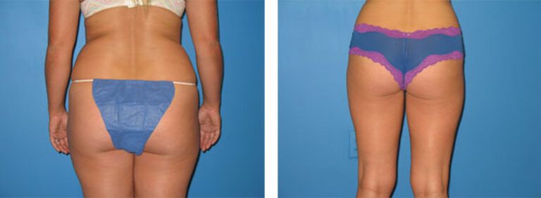 Liposuction-Case-6-2