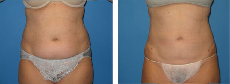 Liposuction-Case-7-1