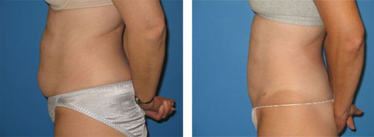 Liposuction-Case-7-2