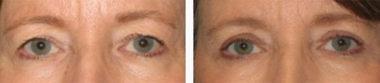 Upper-Blepharoplasty-Case-1