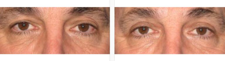 Upper-Blepharoplasty-Case-10