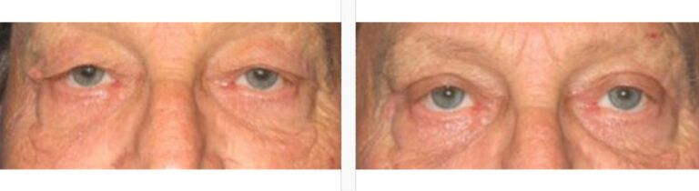 Upper-Blepharoplasty-Case-11