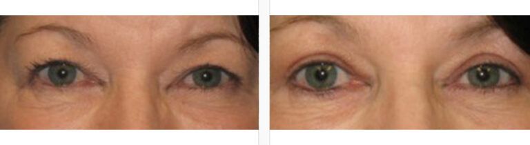 Upper-Blepharoplasty-Case-12