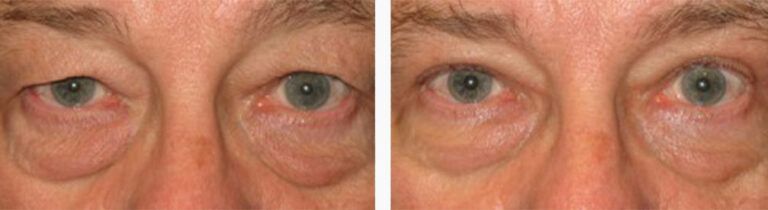 Upper-Blepharoplasty-Case-13