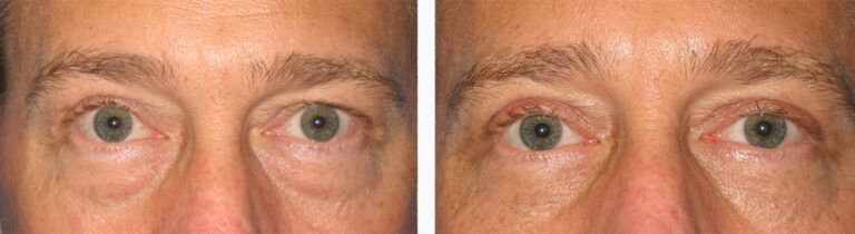 Upper-Blepharoplasty-Case-14