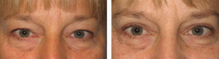 Upper-Blepharoplasty-Case-15