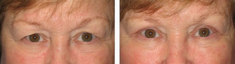 Upper-Blepharoplasty-Case-16