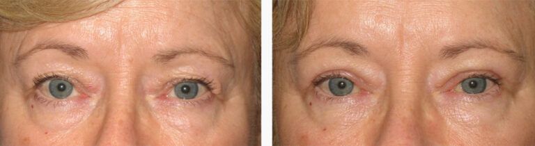 Upper-Blepharoplasty-Case-17