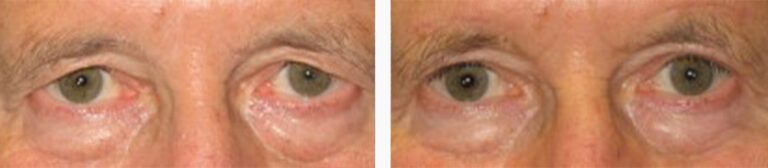 Upper-Blepharoplasty-Case-2