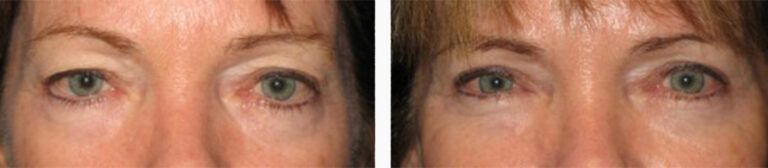 Upper-Blepharoplasty-Case-3
