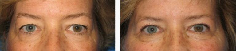 Upper-Blepharoplasty-Case-4