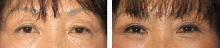 Upper-Blepharoplasty-Case-5