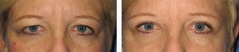Upper-Blepharoplasty-Case-6