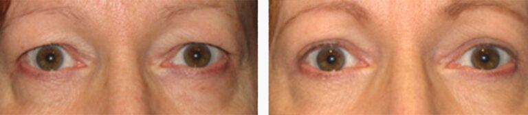 Upper-Blepharoplasty-Case-7