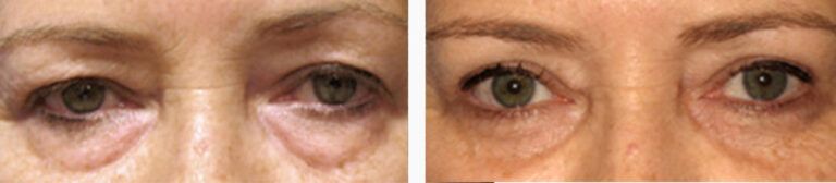 Upper-Blepharoplasty-Case-8