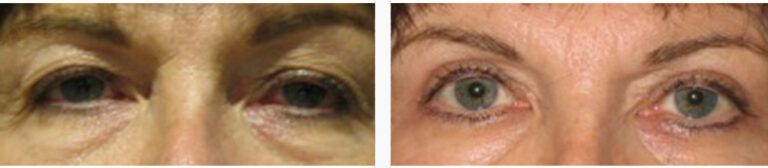 Upper-Blepharoplasty-Case-9