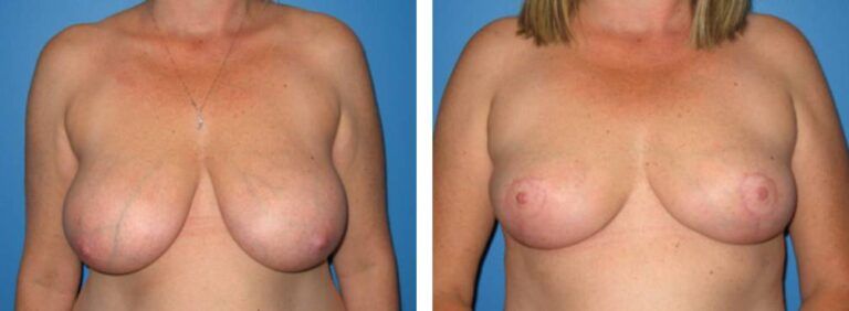 Breast Reduction case 16