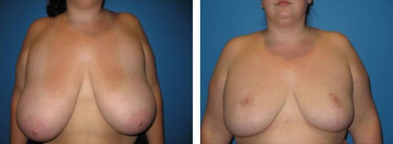 Breast Reduction case 17