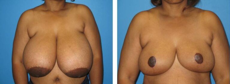 Breast Reduction case 19_1