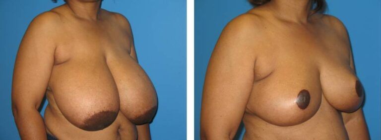 Breast Reduction case 19_2