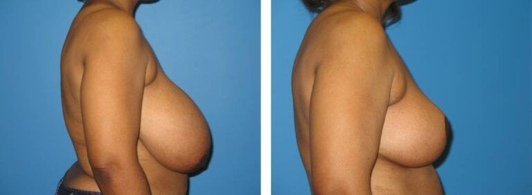 Breast Reduction case 19_3