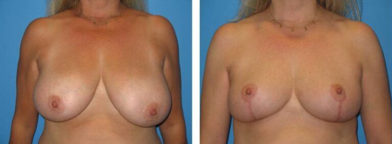 Breast Reduction case 20_1