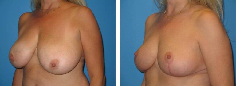 Breast Reduction case 20_2
