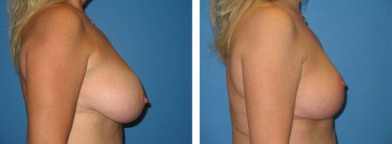 Breast Reduction case 20_3