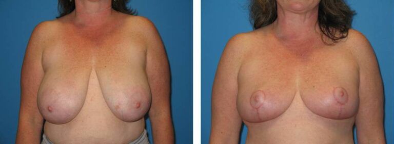 Breast Reduction case 21_1