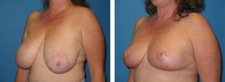 Breast Reduction case 21_2