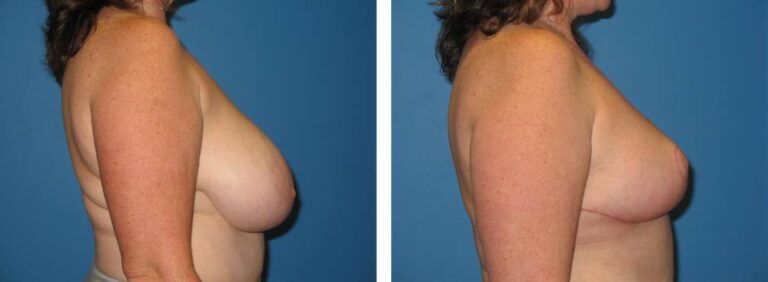 Breast Reduction case 21_3