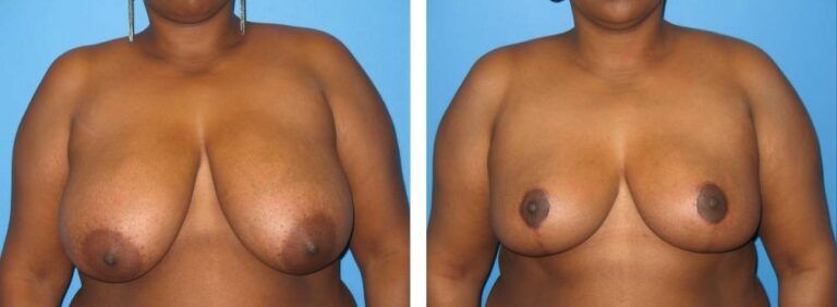 Breast Reduction case 22_1