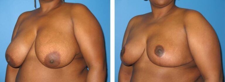 Breast Reduction case 22_2