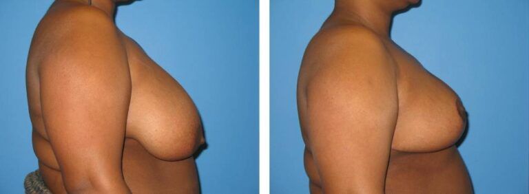 Breast Reduction case 22_3