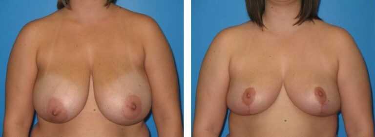 Breast Reduction case 23