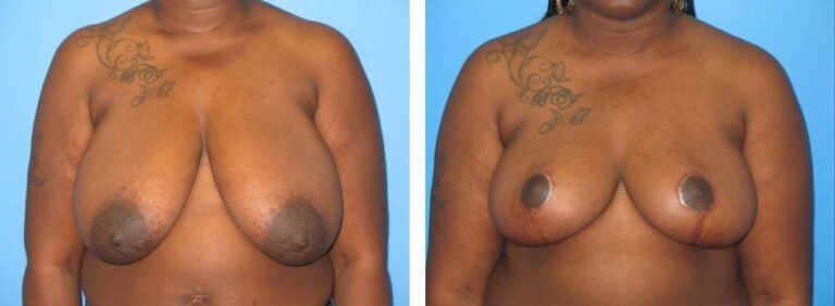 Breast Reduction case 24