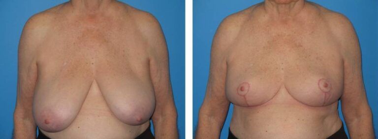 Breast Reduction case 25