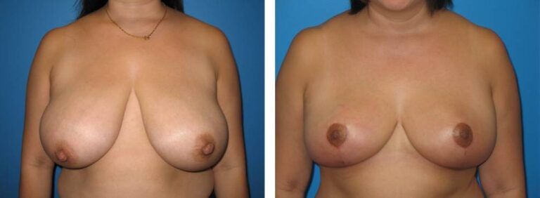 Breast Reduction case 26