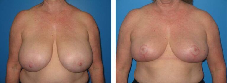Breast Reduction case 27