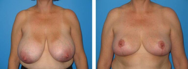 Breast Reduction case 28