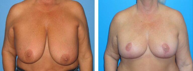 Breast Reduction case 29